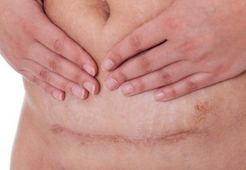 Cảm giác nào sau phẫu thuật có thể là dấu hiệu của thoát vị vết mổ